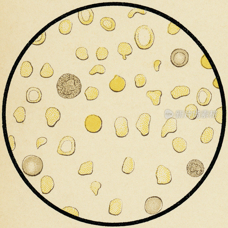 人类血红蛋白血症患者血液细胞的显微镜观察- 19世纪